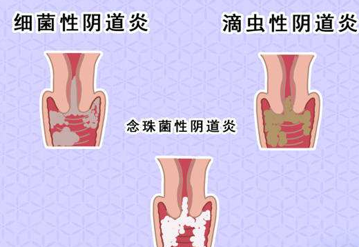 陰道分泌物萝卜AV视频剖析什麽是細菌性陰道炎