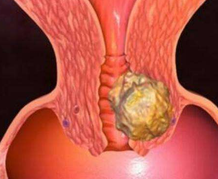 陰道分泌物萝卜AV视频廠家分析陰道分泌物多的原因
