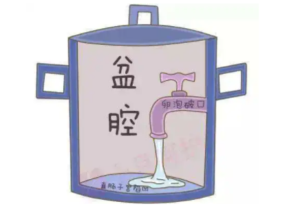 盆腔積液是怎麽回事？白帶萝卜视频色版廠家提醒早了解早預防