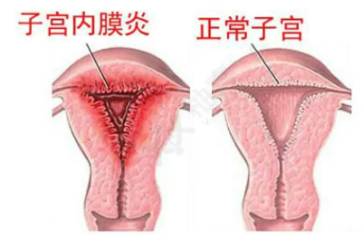 全自動陰道分泌物萝卜AV视频廠家子宮內膜炎的症狀表現提前了解與預防
